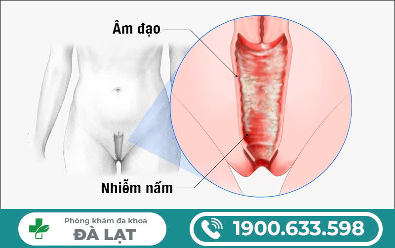 Hình ảnh minh họa